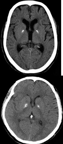 a. 正常脑ct b. 苍白球钙化 c. 腔隙性脑梗死 d. 脑出血 e. 脑萎缩